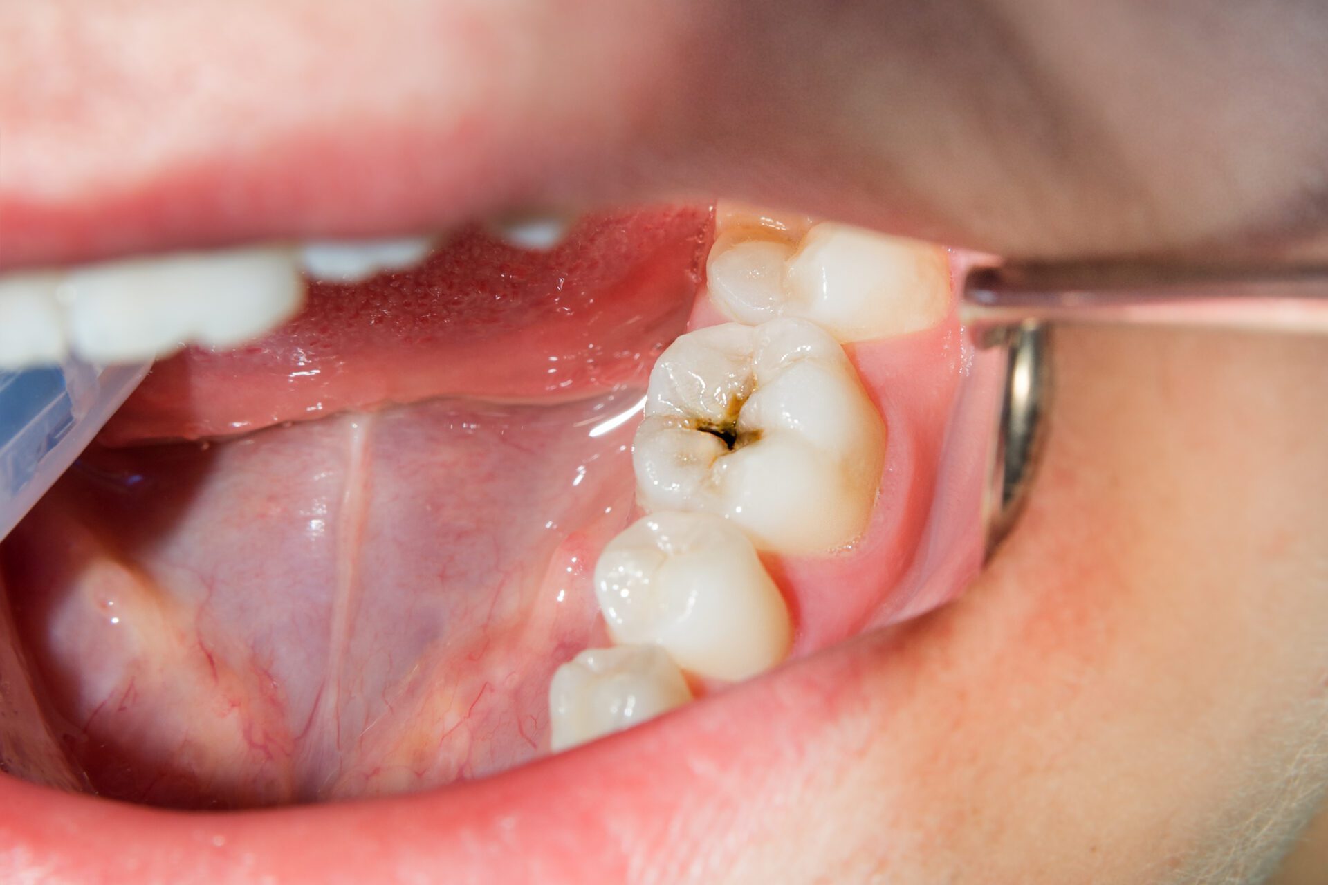 signs of cavity