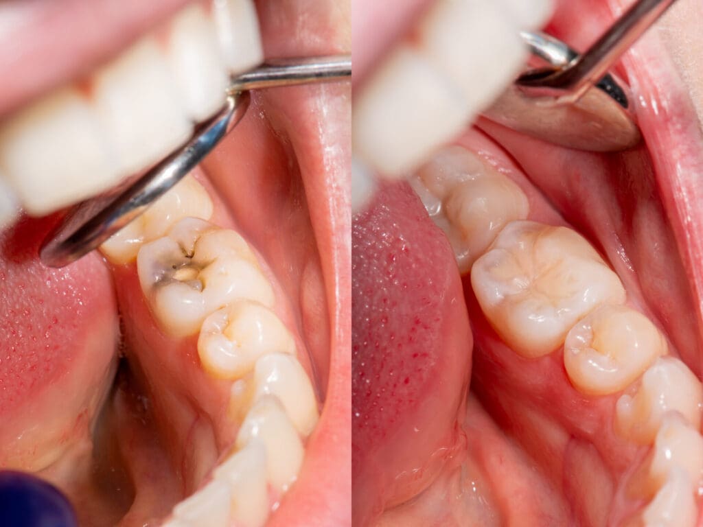 Top 5 Signs and Symptoms of Cavities
